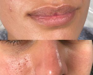 Acne scarsTreatment