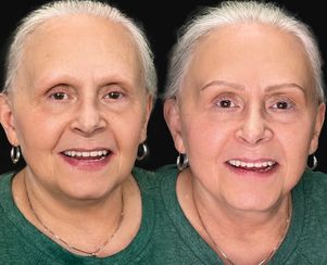 Alopecia Nano Eyebrows/Nanoblading