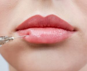 Dermal Fillers