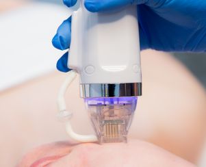 Fractional RF Microneedling