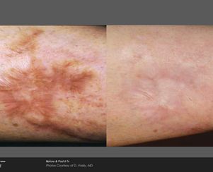 Icon Laser 1540 scar treatment