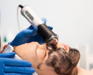 Laser Carbon Facial Peel