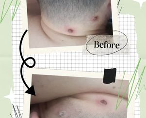 Mole & Skin Tags Removal