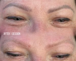 Pico Laser PMU Tattoo Removal