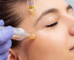 PRP Microneedling